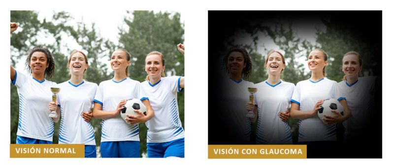 glaucoma-la-ceguera-silenciosa