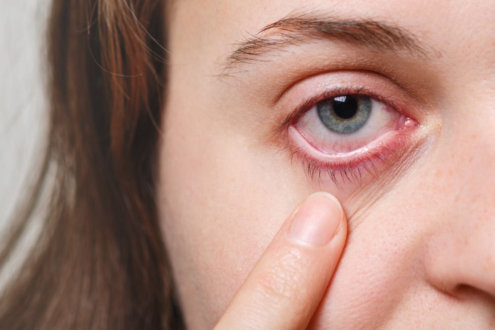 Cómo afecta la alergia si usas lentillas
